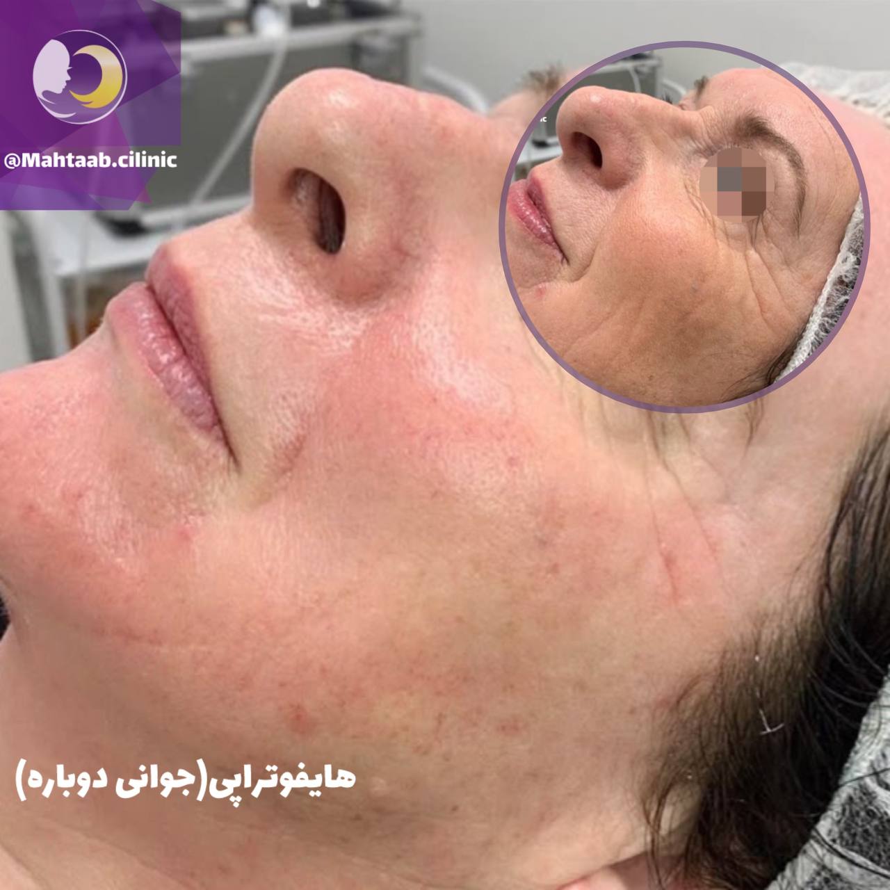 جوانسازی و هایفوتراپی در کرج